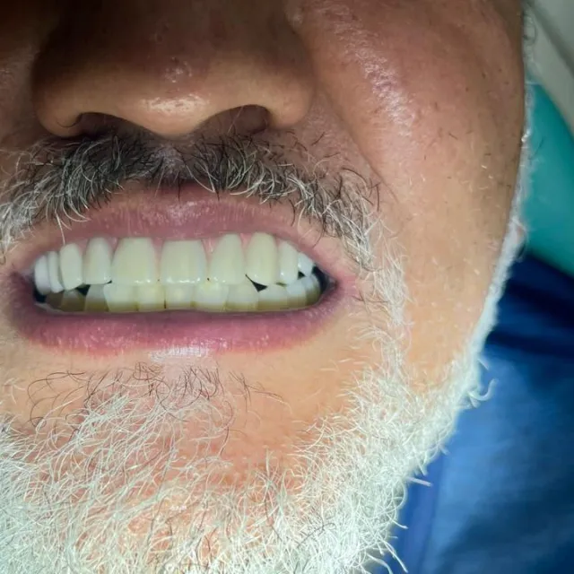 Caso 03, depois do tratamento